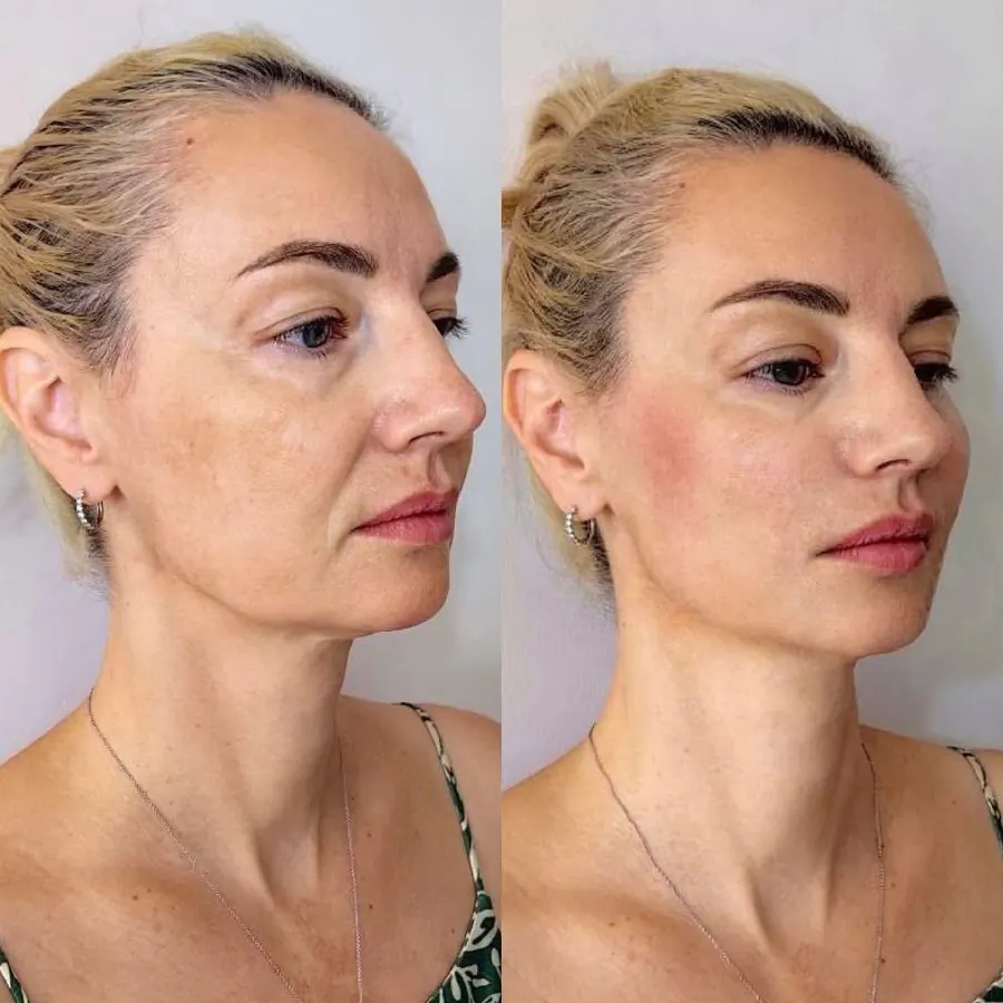 Harmonização Facial